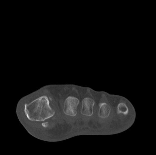 Anterior calcaneal process fracture (Radiopaedia 47384-51989 Coronal bone window 23).png