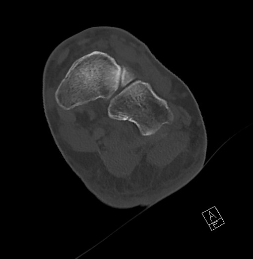 Anterior calcaneal process fracture (Radiopaedia 63353-71943 Axial bone window 86).jpg