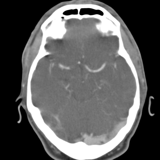 File:Anterior cerebral artery territory infarct (Radiopaedia 39327-41581 B 36).png
