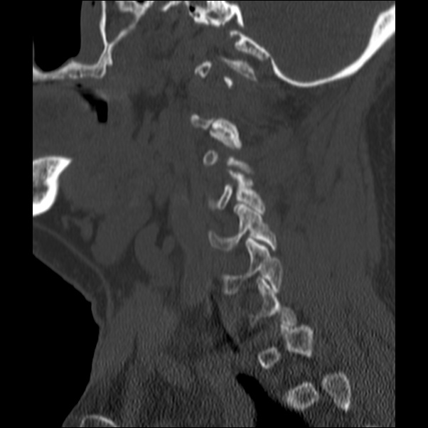 Anterior cervical postdiscectomy arthrodesis (Radiopaedia 32678-33646 Sagittal bone window 60).jpg