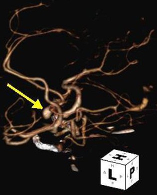 File:Anterior communicating artery aneurysm (Radiopaedia 16633-16335 3D 1).jpg