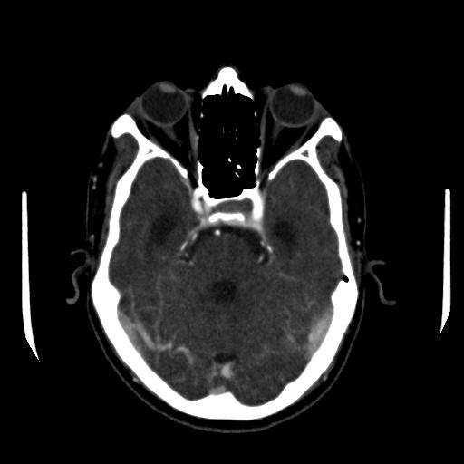 File:Anterior communicating artery aneurysm (Radiopaedia 16633-16335 A 13).jpg