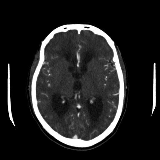 File:Anterior communicating artery aneurysm (Radiopaedia 16633-16335 A 22).jpg