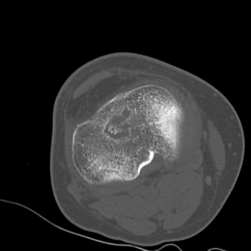 File:Anterior cruciate ligament avulsion fracture (Radiopaedia 58939-66194 Axial bone window 18).jpg