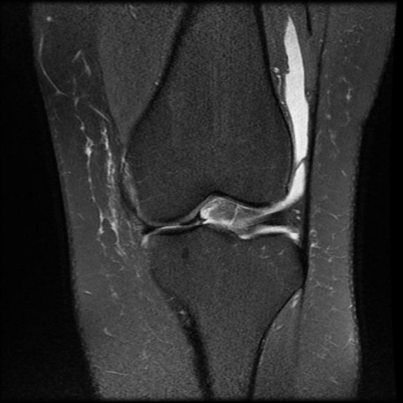 File:Anterior cruciate ligament tear, Wrisberg rip and bucket-handle tear of medial meniscus (Radiopaedia 75872-87266 Coronal PD fat sat 12).jpg