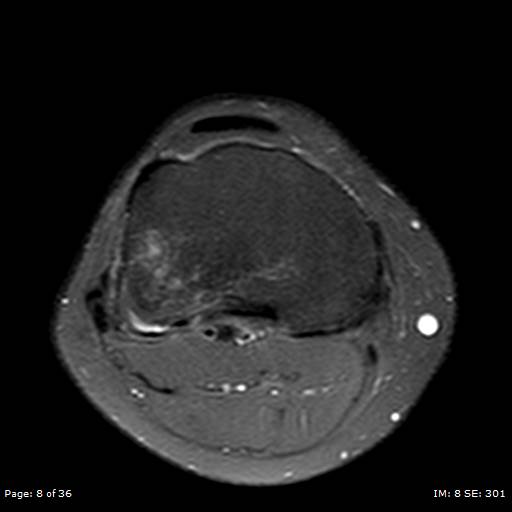 File:Anterior cruciate ligament tear (Radiopaedia 70783-80964 Axial PD fat sat 8).jpg