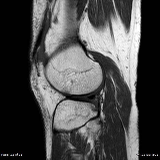 File:Anterior cruciate ligament tear (Radiopaedia 70783-80964 Sagittal T1 23).jpg