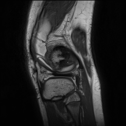 Anterior cruciate ligament tear - pediatric (Radiopaedia 62152-70260 Sagittal PD 145).jpg