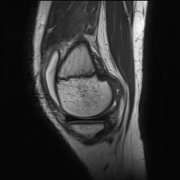 Anterior cruciate ligament tear - pediatric (Radiopaedia 62152-70260 Sagittal PD 40).jpg