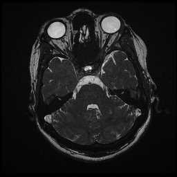 File:Anterior inferior cerebellar artery vascular loop - type 1 (Radiopaedia 69787).jpg