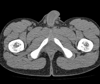 Anterior inferior iliac spine avulsion fracture (Radiopaedia 81312-94999 Axial non-contrast 70).jpg