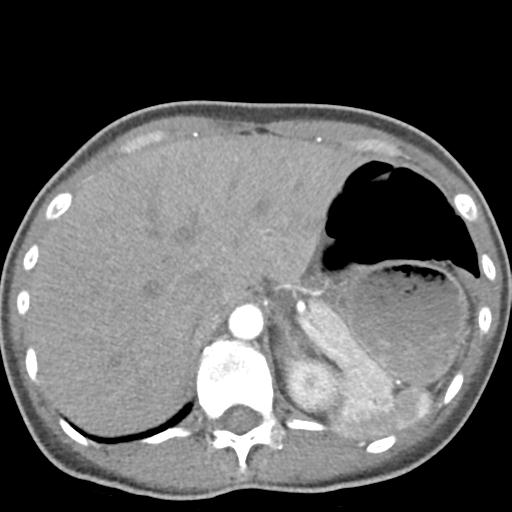 File:Anterior mediastinal lymphoma (Radiopaedia 29556-30061 C 53).jpg