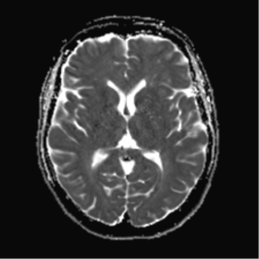 File:Anterior temporal lobe perivascular space (Radiopaedia 40946-43650 Axial ADC 14).png