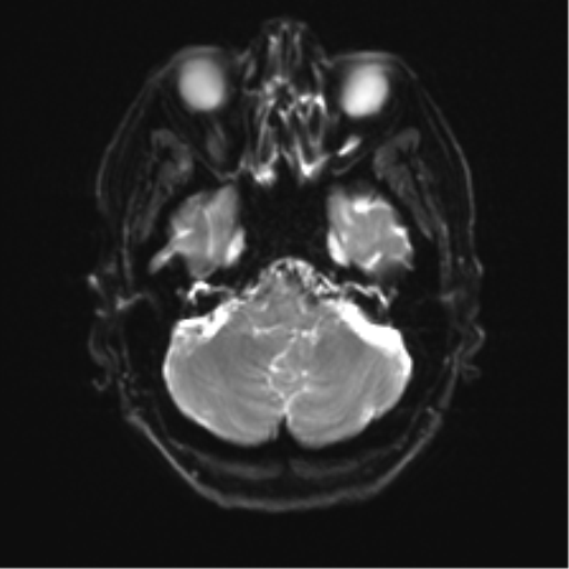 Anterior temporal pole cysts (Radiopaedia 46629-51102 Axial DWI 6).png