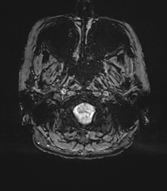 Anterior temporal pole cysts (Radiopaedia 46629-51102 Axial SWI 8).png