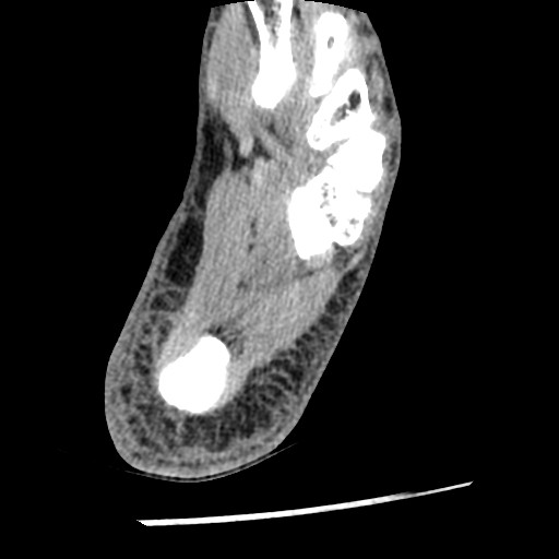 Anterior tibial artery false aneurysm (Radiopaedia 88984-105809 A 219).jpg