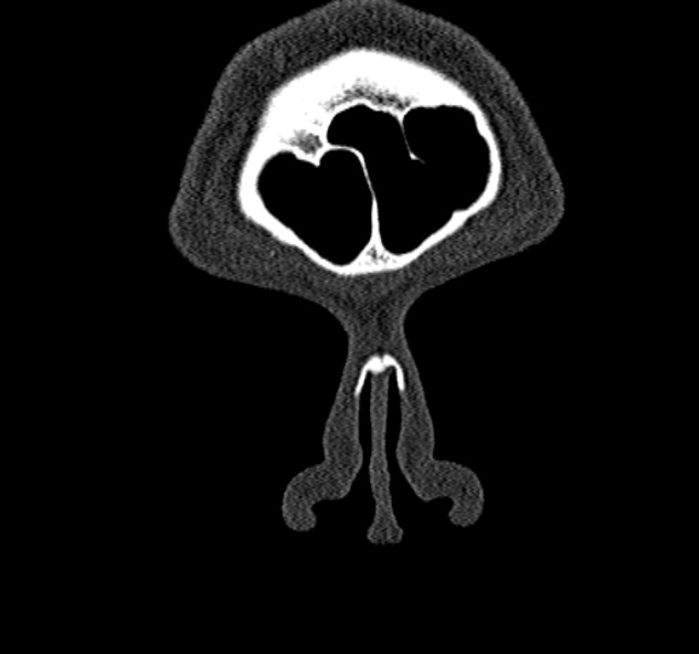Antrochoanal polyp (Radiopaedia 30002-30554 Coronal bone window 6).jpg