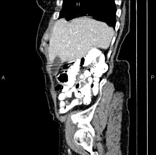File:Aortic aneurysm and Lemmel syndrome (Radiopaedia 86499-102554 D 14).jpg