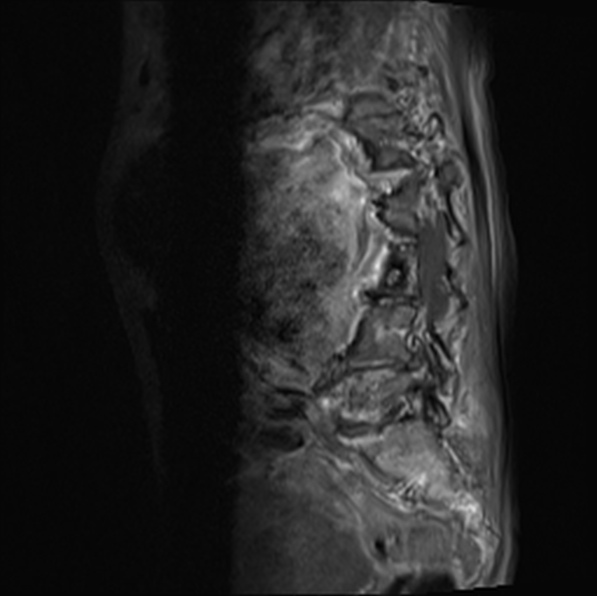 File:Aortic aneurysm with spinal destruction (Radiopaedia 42301-45409 Sagittal T1 fat sat 30).jpg
