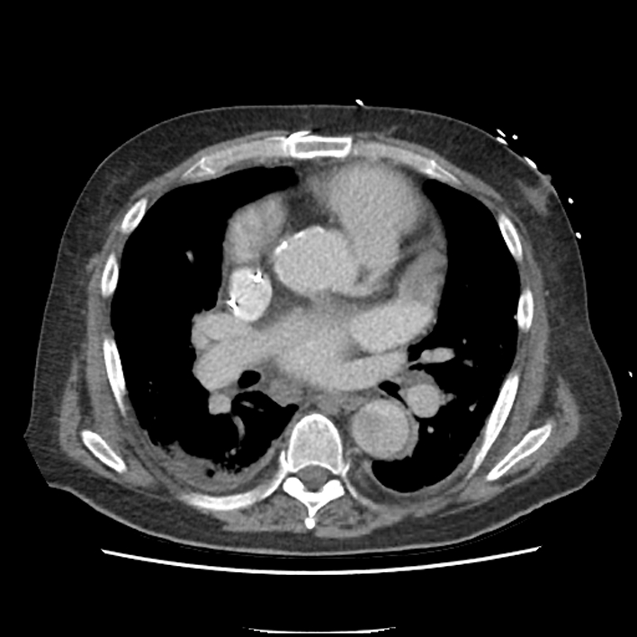 Aortic arch graft infection (FDG PET-CT) (Radiopaedia 71975-82437 A 29).jpg