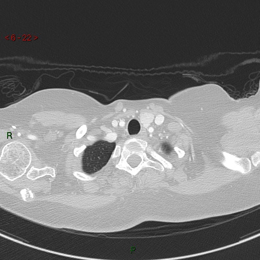 File:Aortic arch origin of left vertebral artery (Radiopaedia 51520-57286 Axial lung window 22).jpg