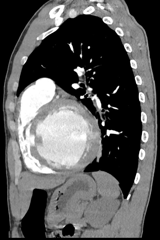 Aortic coarctation with aneurysm (Radiopaedia 74818-85828 B 110).jpg