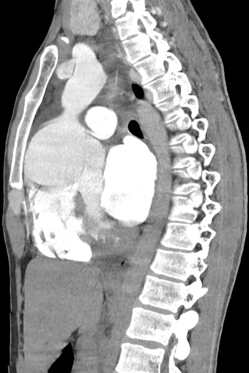 Aortic coarctation with aneurysm (Radiopaedia 74818-85828 B 88).jpg