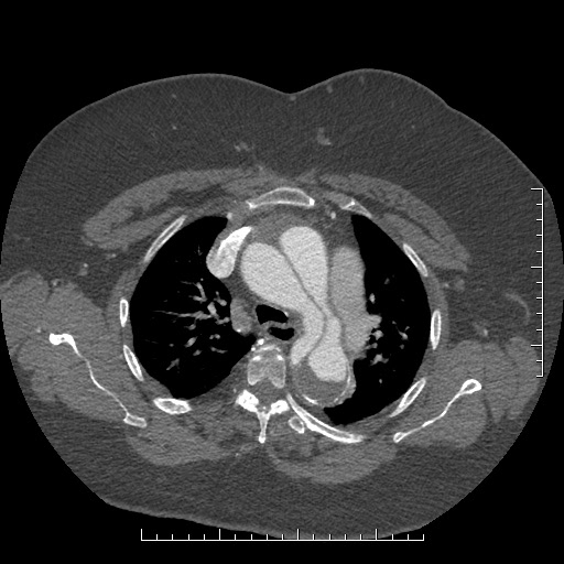 Aortic dissection- Stanford A (Radiopaedia 35729-37268 A 23).jpg