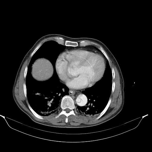 Aortic dissection- Stanford type A (Radiopaedia 22085-22085 A 28).jpg