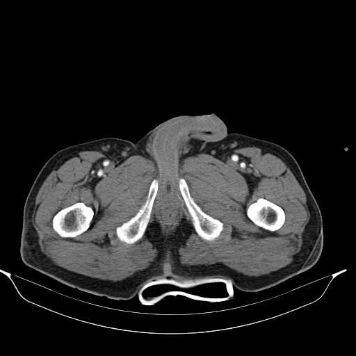 Aortic dissection- Stanford type A (Radiopaedia 22085-22085 A 85).jpg