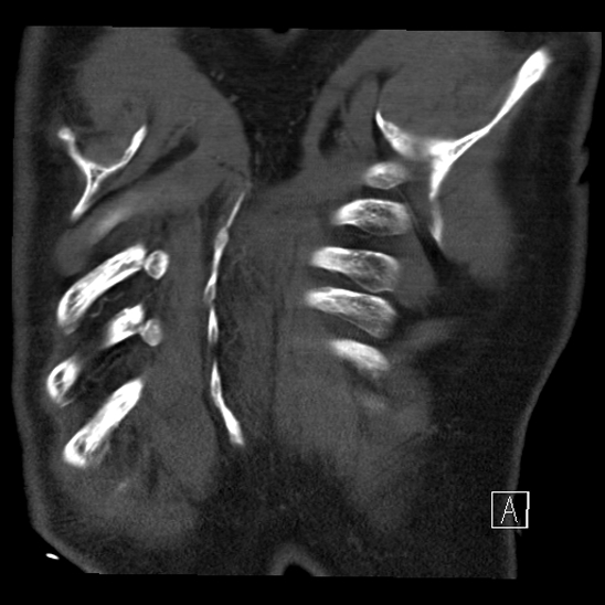 Aortic dissection (CTPA) (Radiopaedia 75506-86750 B 70).jpg