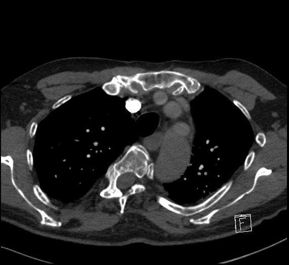 File:Aortic dissection (CTPA) (Radiopaedia 75506-86751 Axial C+ CTPA 35).jpg
