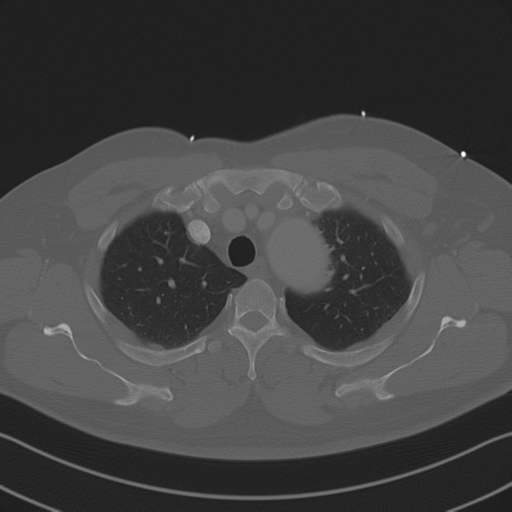 File:Aortic dissection (Radiopaedia 50763-56234 Axial bone window 27).png