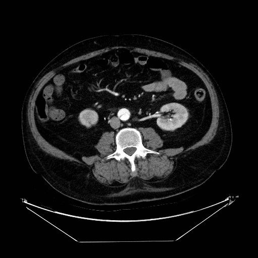 Aortic dissection (Radiopaedia 62562-71000 A 74).jpg