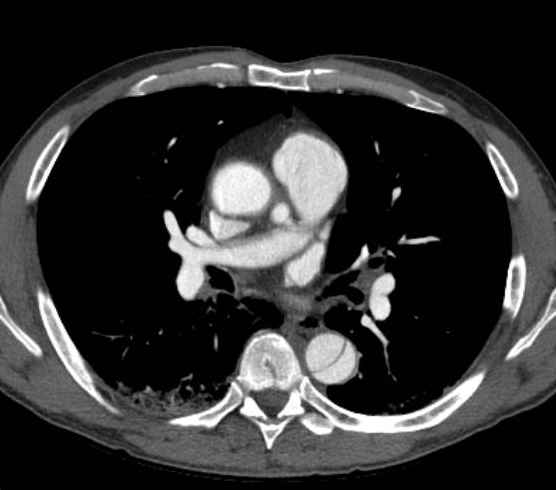 Aortic dissection - Stanford type B (Radiopaedia 73648-84437 A 52).jpg