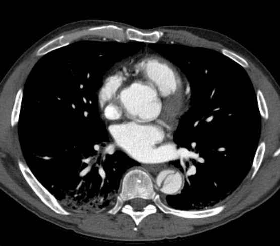 File:Aortic dissection - Stanford type B (Radiopaedia 73648-84437 A 62).jpg