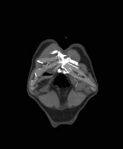 Aortic dissection - Stanford type B (Radiopaedia 73648-84437 B 4).jpg