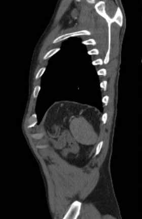 File:Aortic dissection - Stanford type B (Radiopaedia 73648-84437 C 15).jpg