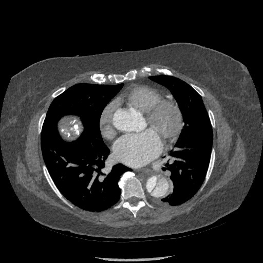 Aortic dissection - Stanford type B (Radiopaedia 88281-104910 A 51).jpg