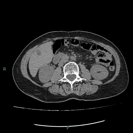 File:Aortic dissection extended to lusory artery (Radiopaedia 43686-47136 Axial non-contrast 37).jpg