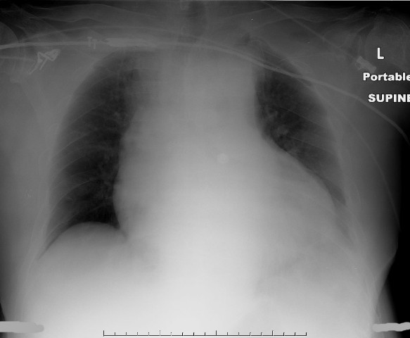 File:Aortic dissection with rupture into the pericardial sac (Radiopaedia 23726-23878 Frontal 1).jpg