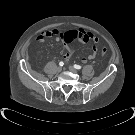 Aortic intramural hematoma (Radiopaedia 34260-35540 B 73).png