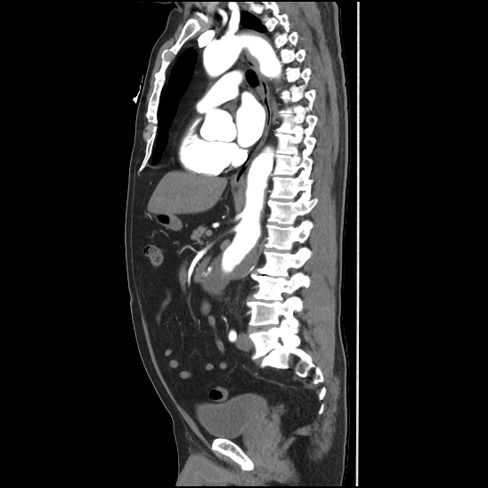Aortic intramural hematoma (type B) (Radiopaedia 79323-92387 H 28).jpg