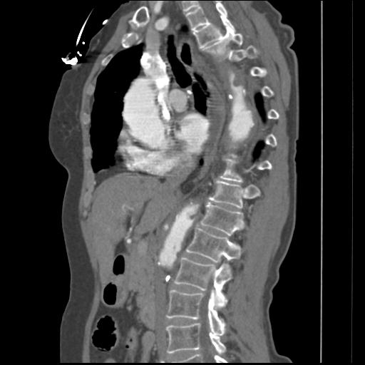 File:Aortic intramural hematoma from penetrating atherosclerotic ulcer (Radiopaedia 31137-31836 B 23).jpg