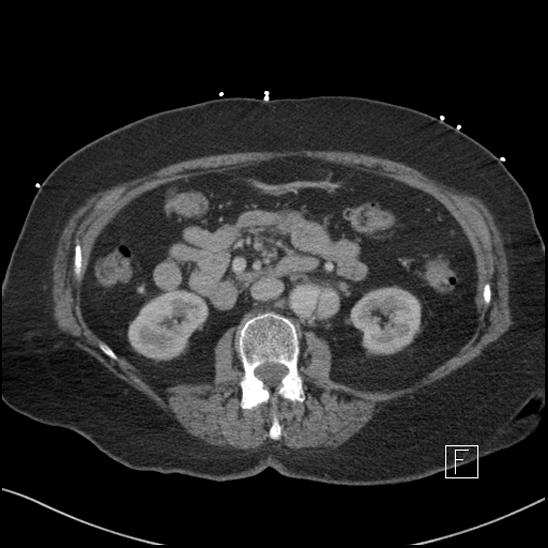 Aortic intramural hematoma with dissection and intramural blood pool (Radiopaedia 77373-89491 E 34).jpg
