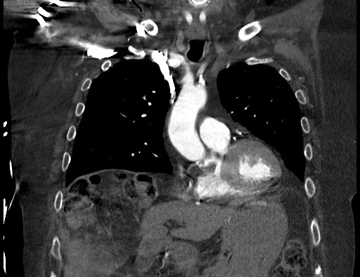 Aortoesophageal fistula with endovascular repair (Radiopaedia 73781-84592 Coronal C+ CTPA 39).jpg