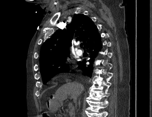 Aortoesophageal fistula with endovascular repair (Radiopaedia 73781-84592 Sagittal C+ CTPA 78).jpg