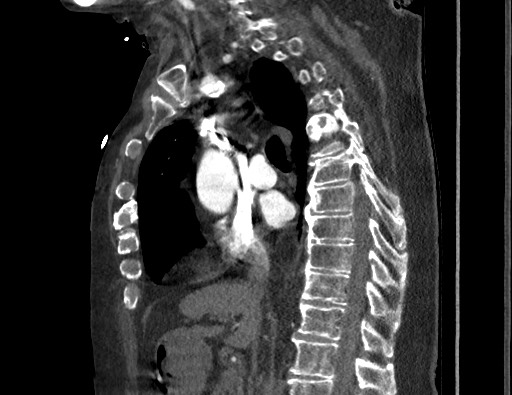 Aortoesophageal fistula with endovascular repair (Radiopaedia 73781-84592 Sagittal C+ CTPA 88).jpg