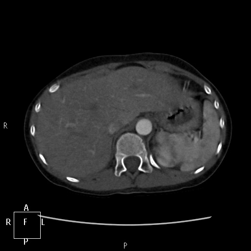 File:Aortopulmonary septal defect (Radiopaedia 41990-45013 Axial C+ CTPA 1).jpg