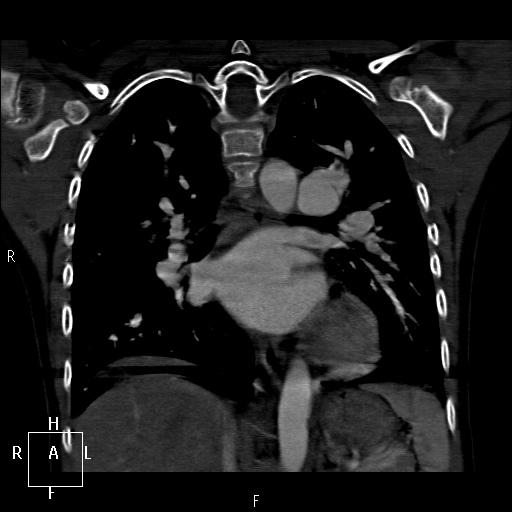 File:Aortopulmonary septal defect (Radiopaedia 41990-45013 Coronal C+ CTPA 42).jpg